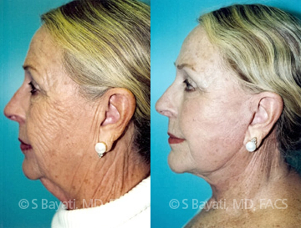 Real Patient Results in Newport Beach, CA. Preformed by Semira Bayait, MD, FACS.