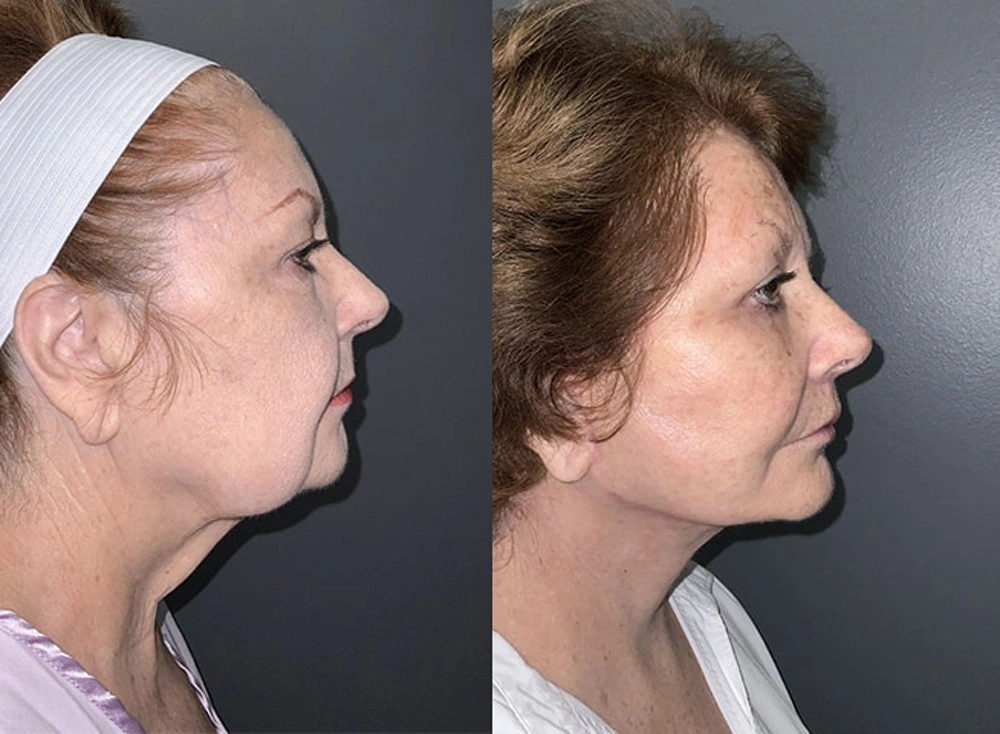 Real Patient Results in Newport Beach, CA. Preformed by Semira Bayait, MD, FACS.