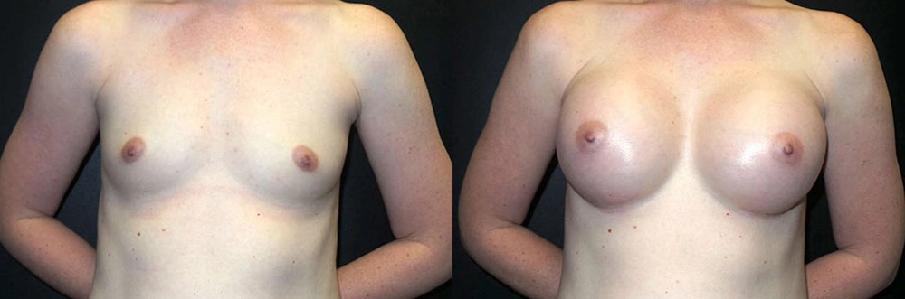 Real Patient Results in Newport Beach, CA. Preformed by Semira Bayait, MD, FACS.