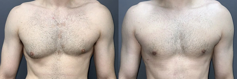 Real Patient Results in Newport Beach, CA. Preformed by Semira Bayait, MD, FACS.