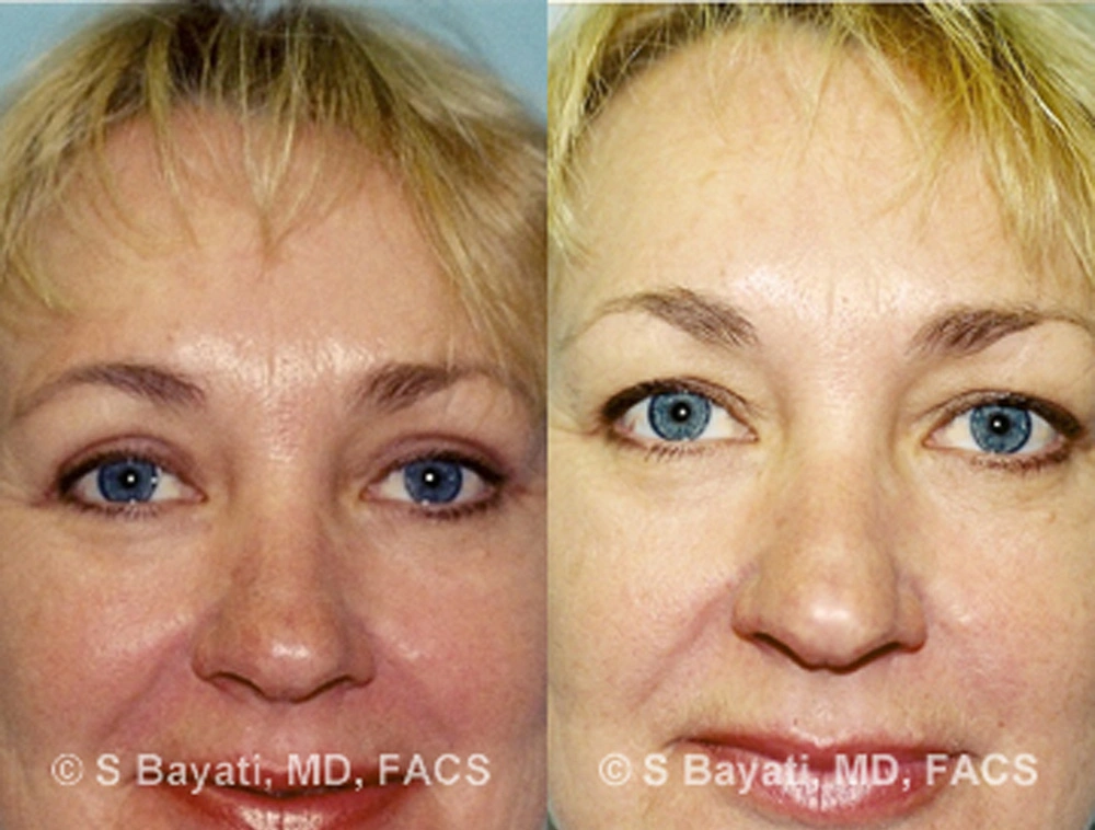 Real Patient Results in Newport Beach, CA. Preformed by Semira Bayait, MD, FACS.