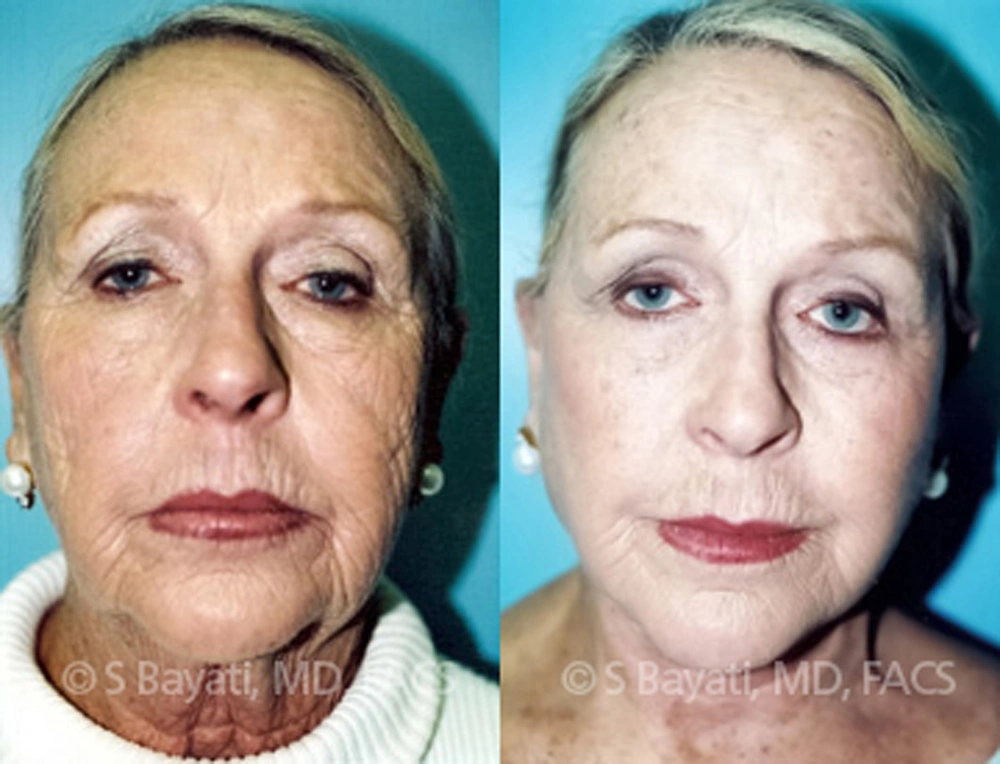 Real Patient Results in Newport Beach, CA. Preformed by Semira Bayait, MD, FACS.