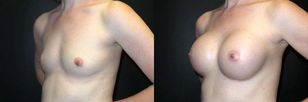 Real Patient Results in Newport Beach, CA. Preformed by Semira Bayait, MD, FACS.