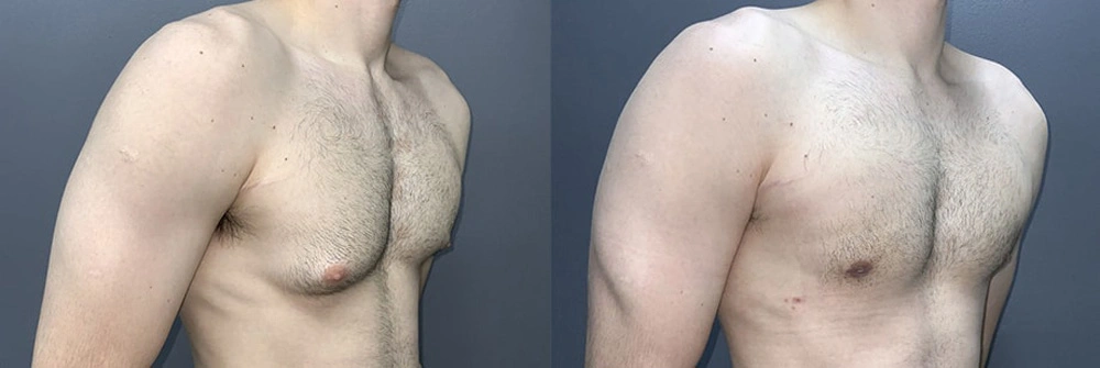 Real Patient Results in Newport Beach, CA. Preformed by Semira Bayait, MD, FACS.