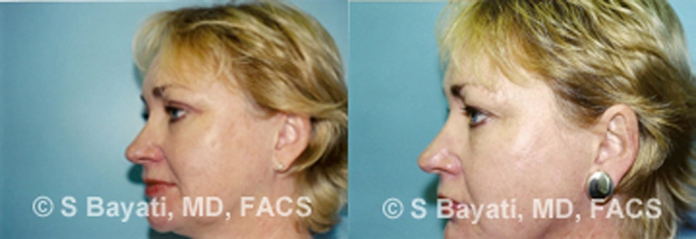 Real Patient Results in Newport Beach, CA. Preformed by Semira Bayait, MD, FACS.