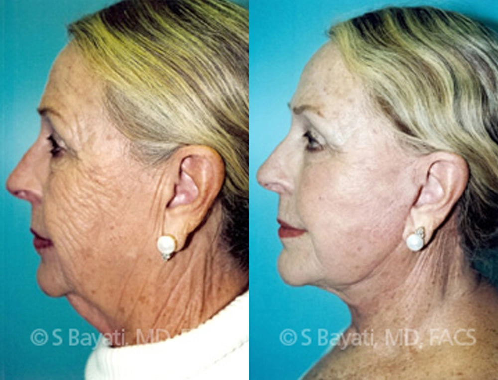 Real Patient Results in Newport Beach, CA. Preformed by Semira Bayait, MD, FACS.
