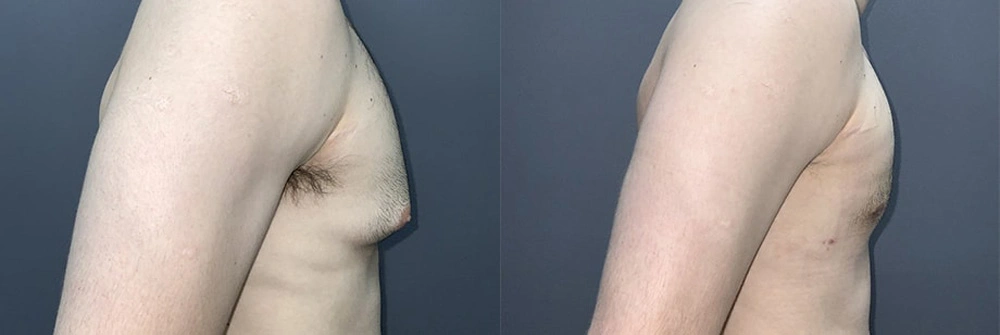 Real Patient Results in Newport Beach, CA. Preformed by Semira Bayait, MD, FACS.