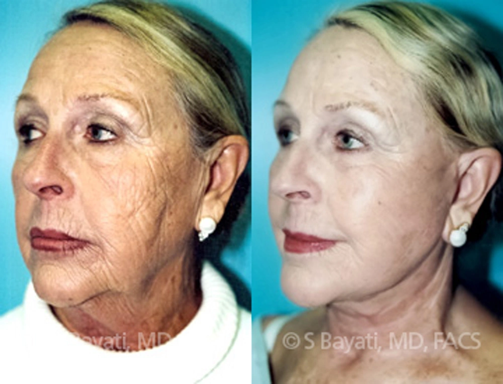 Real Patient Results in Newport Beach, CA. Preformed by Semira Bayait, MD, FACS.