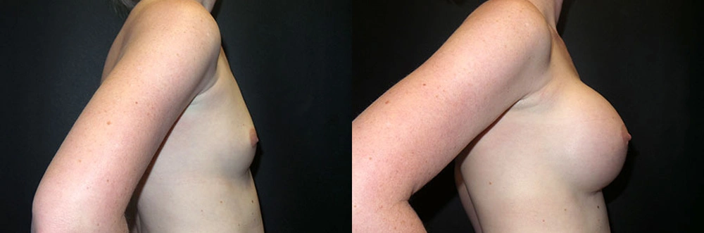 Real Patient Results in Newport Beach, CA. Preformed by Semira Bayait, MD, FACS.