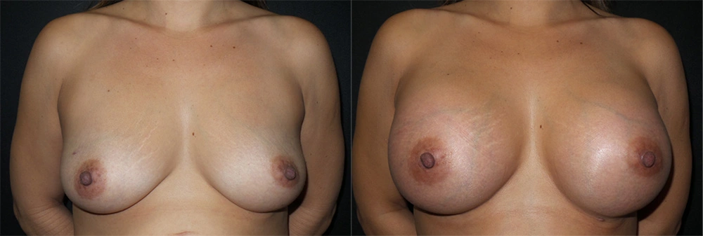 Real Patient Results in Newport Beach, CA. Preformed by Semira Bayait, MD, FACS.