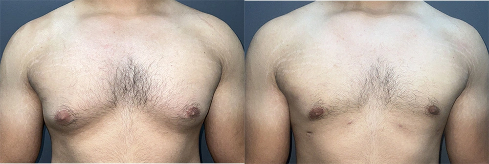 Real Patient Results in Newport Beach, CA. Preformed by Semira Bayait, MD, FACS.