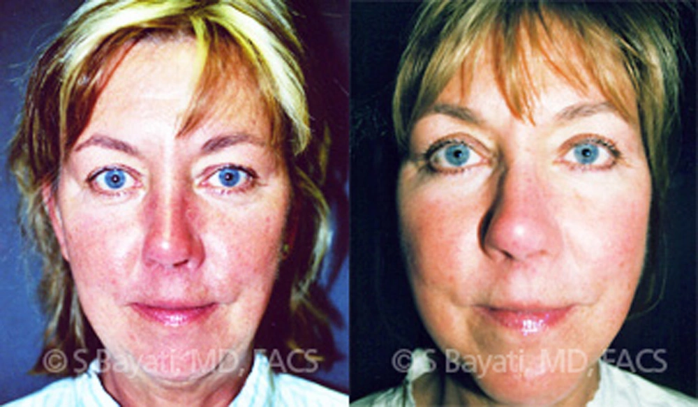 Real Patient Results in Newport Beach, CA. Preformed by Semira Bayait, MD, FACS.