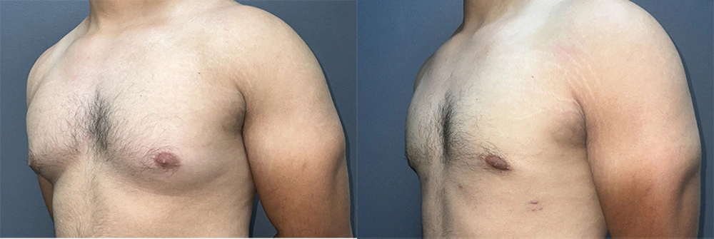 Real Patient Results in Newport Beach, CA. Preformed by Semira Bayait, MD, FACS.