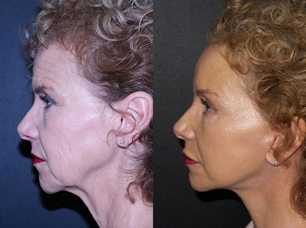 Real Patient Results in Newport Beach, CA. Preformed by Semira Bayait, MD, FACS.