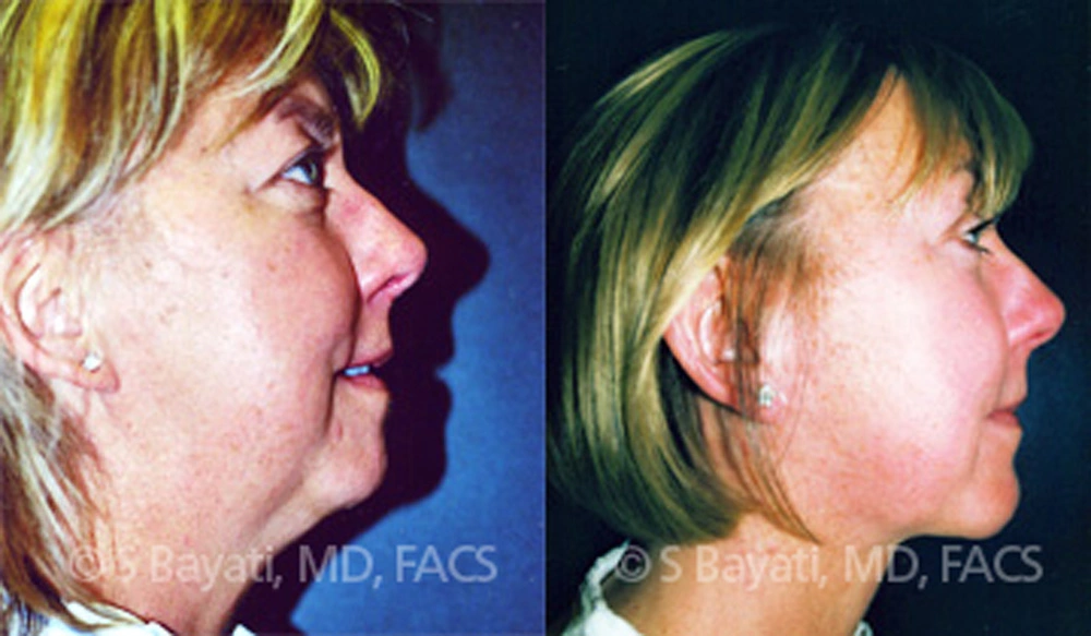 Real Patient Results in Newport Beach, CA. Preformed by Semira Bayait, MD, FACS.
