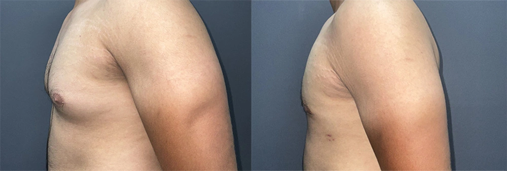 Real Patient Results in Newport Beach, CA. Preformed by Semira Bayait, MD, FACS.