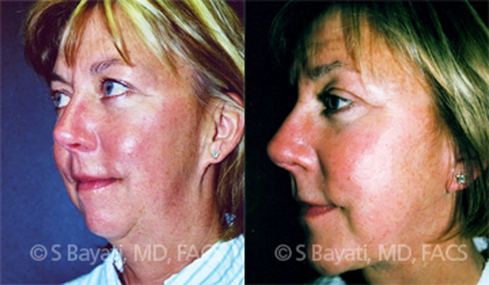 Real Patient Results in Newport Beach, CA. Preformed by Semira Bayait, MD, FACS.