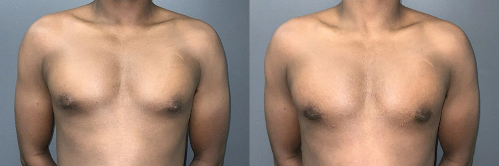 Real Patient Results in Newport Beach, CA. Preformed by Semira Bayait, MD, FACS.