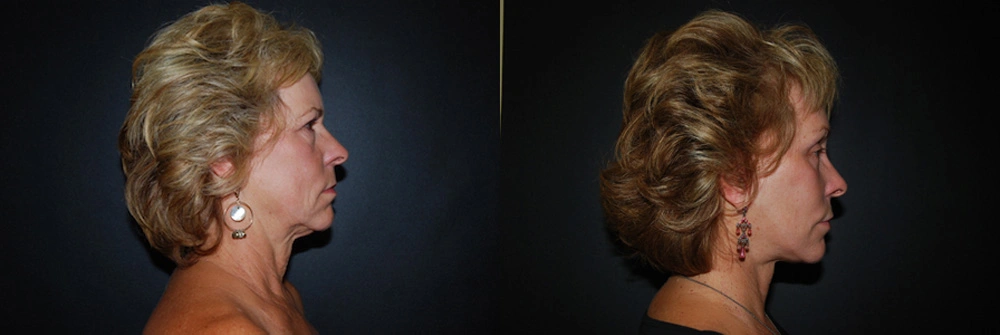 Real Patient Results in Newport Beach, CA. Preformed by Semira Bayait, MD, FACS.