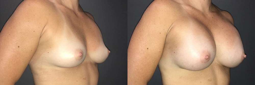 Real Patient Results in Newport Beach, CA. Preformed by Semira Bayait, MD, FACS.v