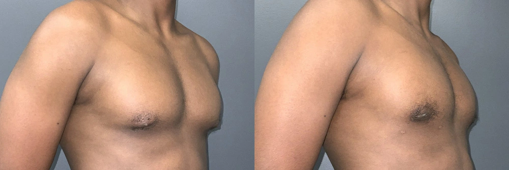 Real Patient Results in Newport Beach, CA. Preformed by Semira Bayait, MD, FACS.