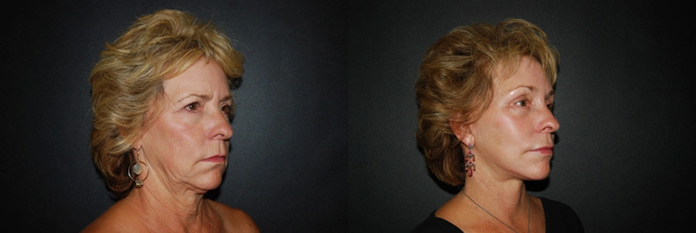Real Patient Results in Newport Beach, CA. Preformed by Semira Bayait, MD, FACS.
