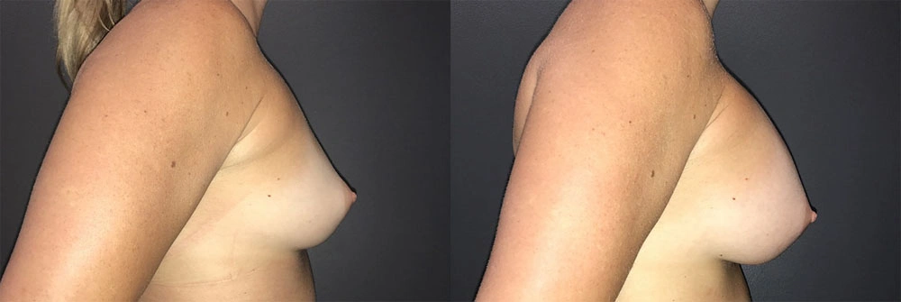 Real Patient Results in Newport Beach, CA. Preformed by Semira Bayait, MD, FACS.