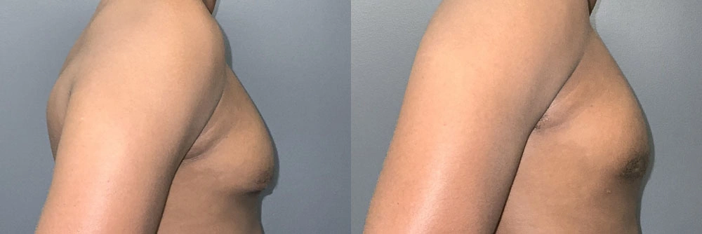 Real Patient Results in Newport Beach, CA. Preformed by Semira Bayait, MD, FACS.