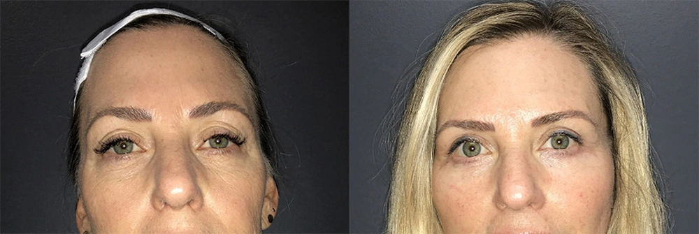 Real Patient Results in Newport Beach, CA. Preformed by Semira Bayait, MD, FACS.