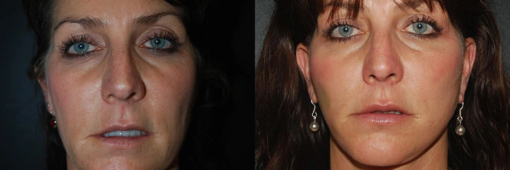 Real Patient Results in Newport Beach, CA. Preformed by Semira Bayait, MD, FACS.
