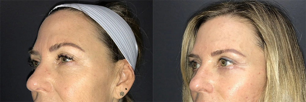 Real Patient Results in Newport Beach, CA. Preformed by Semira Bayait, MD, FACS.