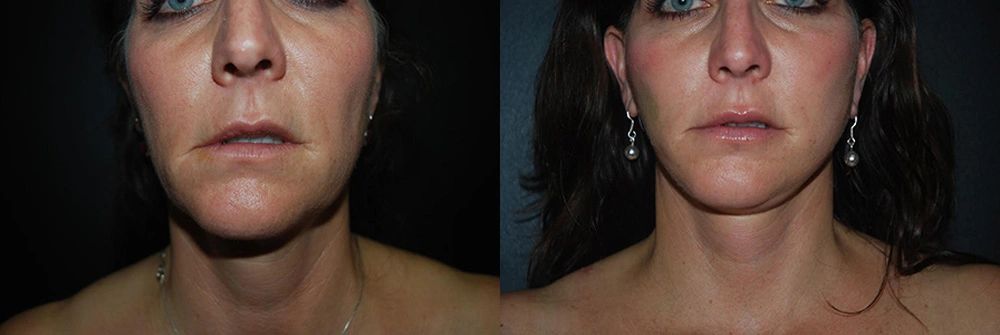 Real Patient Results in Newport Beach, CA. Preformed by Semira Bayait, MD, FACS.