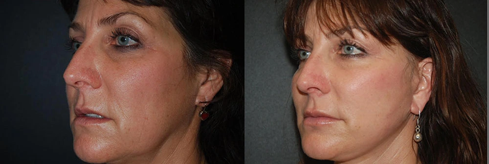 Real Patient Results in Newport Beach, CA. Preformed by Semira Bayait, MD, FACS.