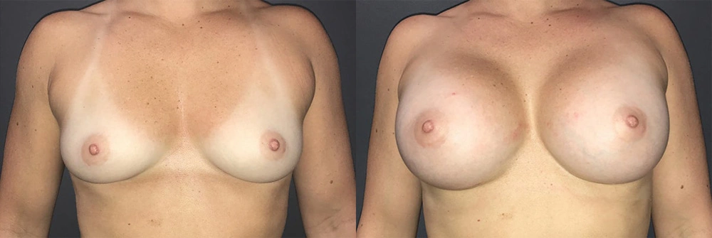 Real Patient Results in Newport Beach, CA. Preformed by Semira Bayait, MD, FACS.