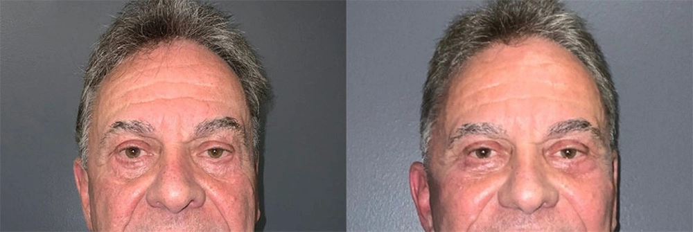 Real Patient Results in Newport Beach, CA. Preformed by Semira Bayait, MD, FACS.