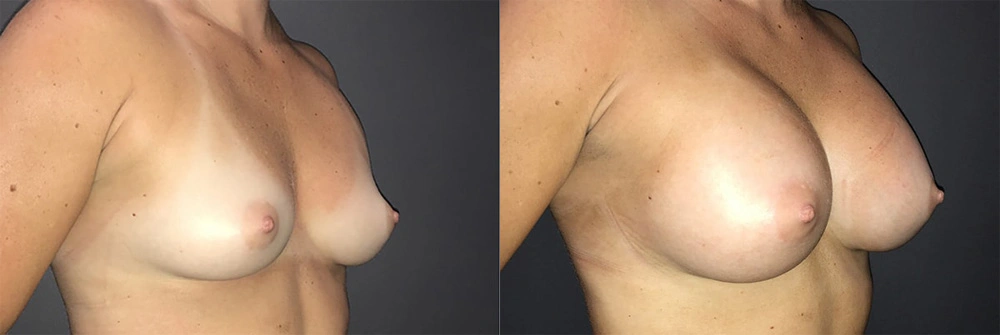 Real Patient Results in Newport Beach, CA. Preformed by Semira Bayait, MD, FACS.