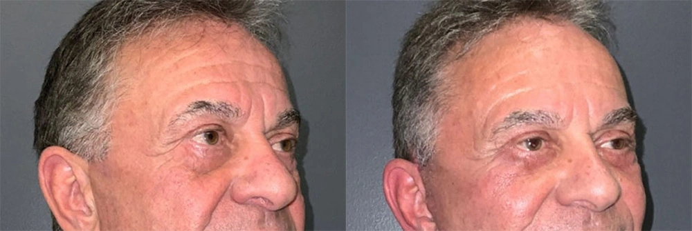 Real Patient Results in Newport Beach, CA. Preformed by Semira Bayait, MD, FACS.