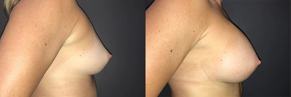Real Patient Results in Newport Beach, CA. Preformed by Semira Bayait, MD, FACS.