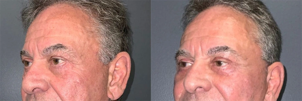 Real Patient Results in Newport Beach, CA. Preformed by Semira Bayait, MD, FACS.