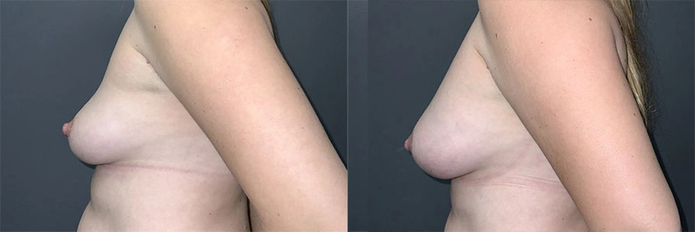 Real Patient Results in Newport Beach, CA. Preformed by Semira Bayait, MD, FACS.