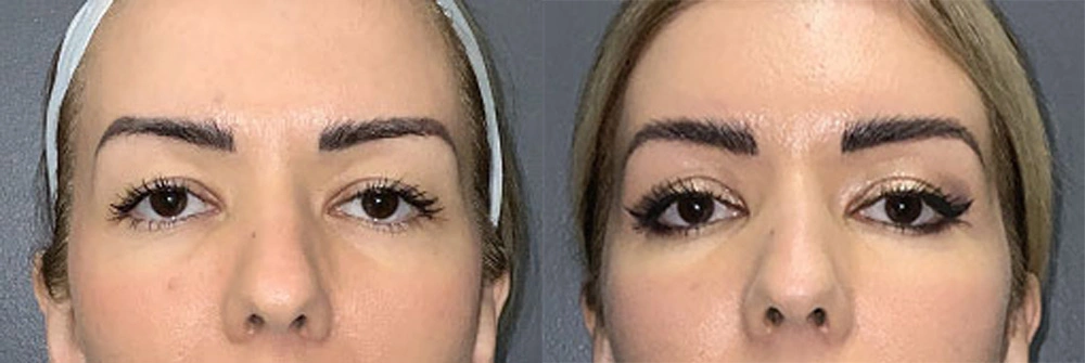 Real Patient Results in Newport Beach, CA. Preformed by Semira Bayait, MD, FACS.