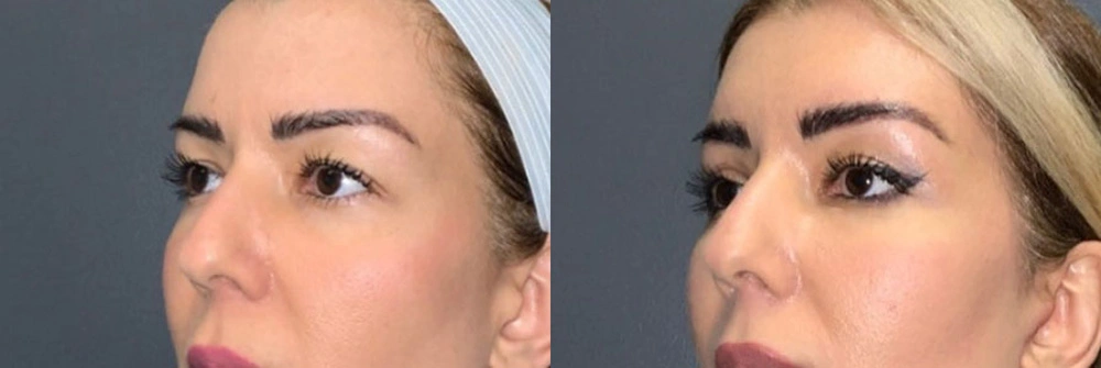 Real Patient Results in Newport Beach, CA. Preformed by Semira Bayait, MD, FACS.