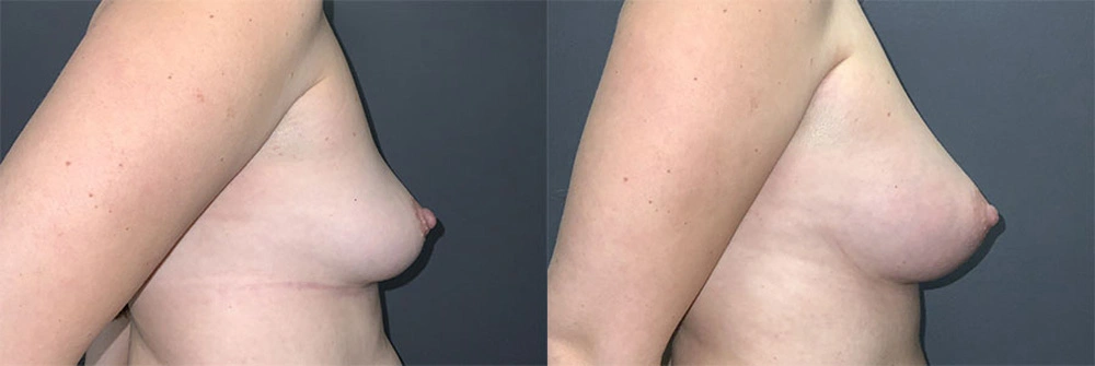 Real Patient Results in Newport Beach, CA. Preformed by Semira Bayait, MD, FACS.