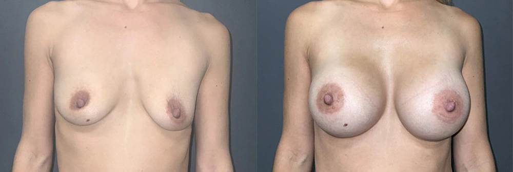 Real Patient Results in Newport Beach, CA. Preformed by Semira Bayait, MD, FACS.