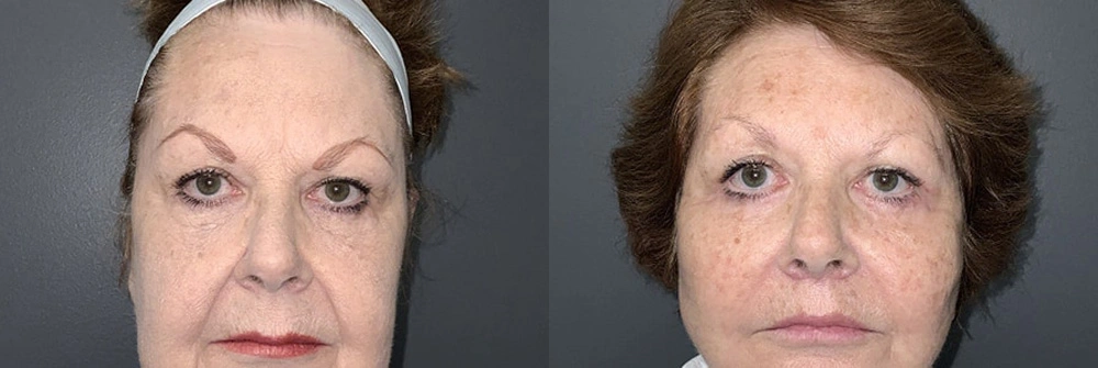 Real Patient Results in Newport Beach, CA. Preformed by Semira Bayait, MD, FACS.