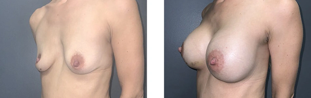 Real Patient Results in Newport Beach, CA. Preformed by Semira Bayait, MD, FACS.