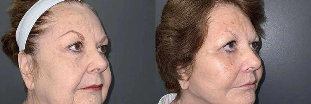 Real Patient Results in Newport Beach, CA. Preformed by Semira Bayait, MD, FACS.