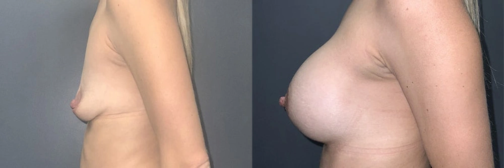 Real Patient Results in Newport Beach, CA. Preformed by Semira Bayait, MD, FACS.
