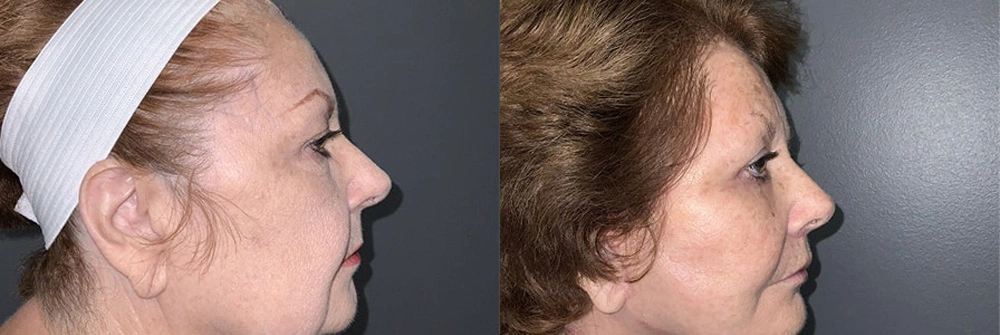 Real Patient Results in Newport Beach, CA. Preformed by Semira Bayait, MD, FACS.