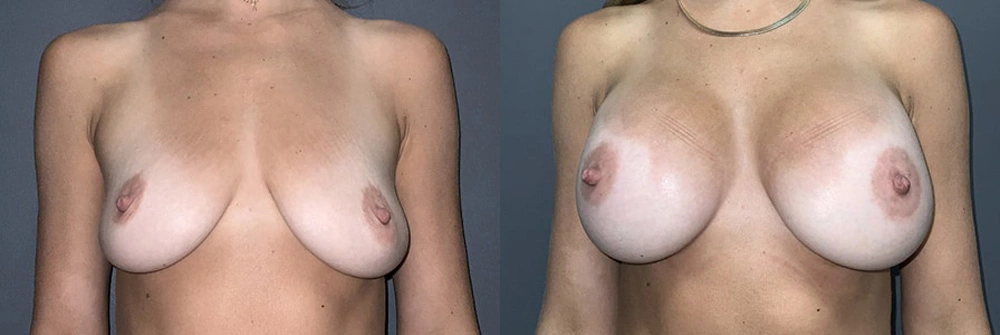 Real Patient Results in Newport Beach, CA. Preformed by Semira Bayait, MD, FACS.